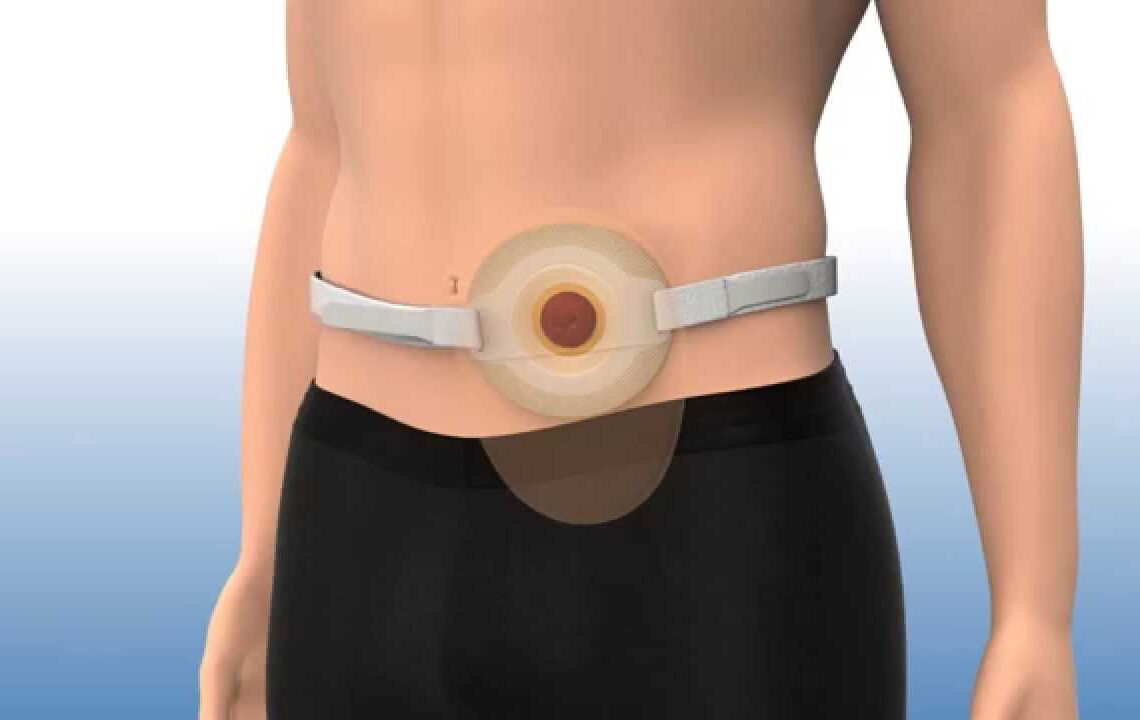 How Do You Use a Stoma Belt?