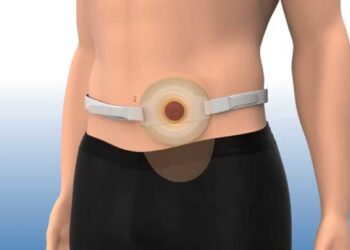 How Do You Use a Stoma Belt?