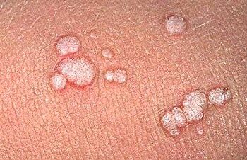 skin tags