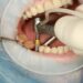 Affordable Dental Implants