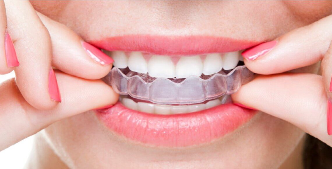 Invisalign - The Complete Guide – Green Record