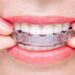 Invisalign - The Complete Guide