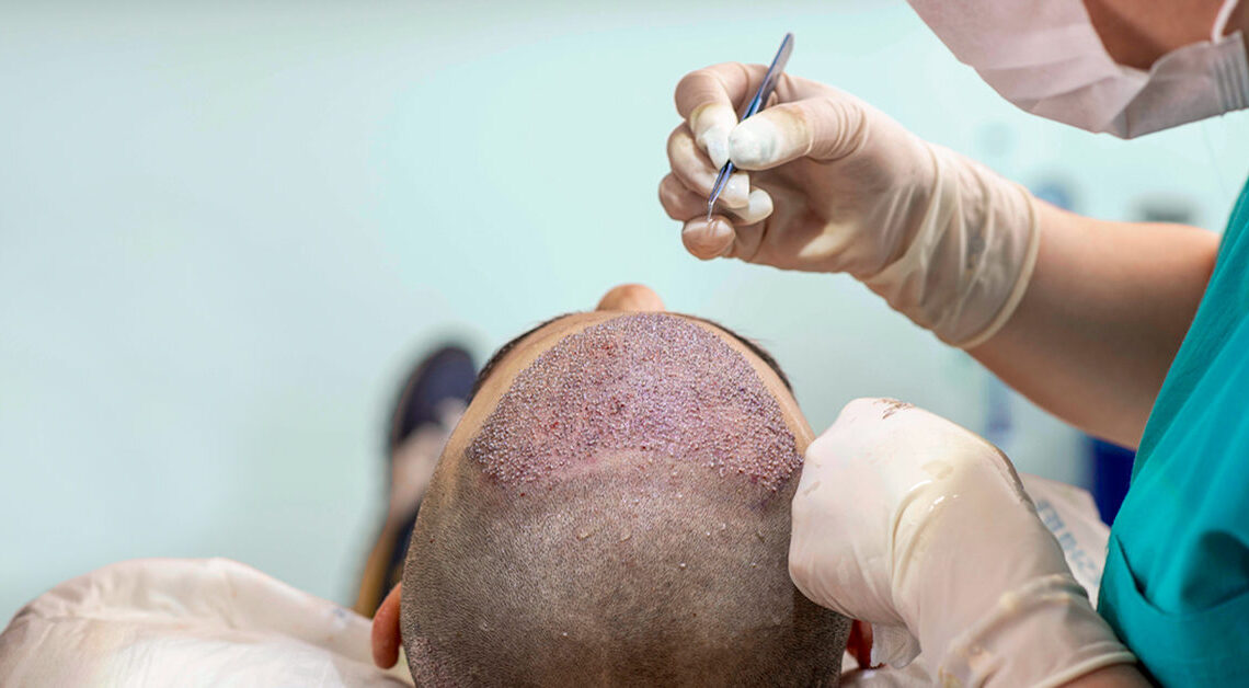 hair transplant