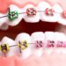 How Do Dental Braces Straighten Teeth