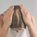 Hair Transplant For Men and Women