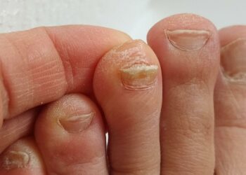 Fungal Nail Infection