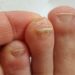 Fungal Nail Infection