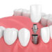 dental implants hungary helvetic clinics