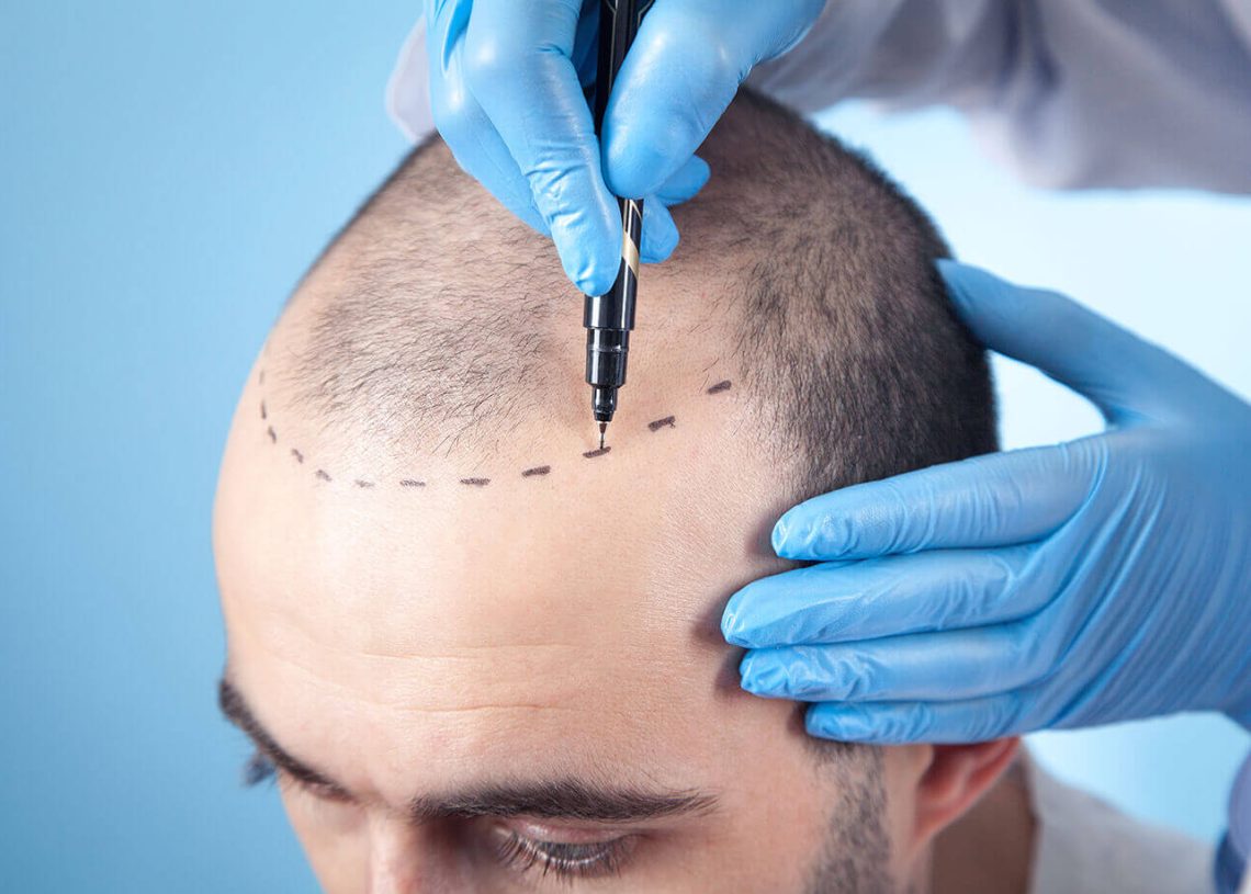 Hair Transplants For Men And Women: Who Are Good Candidates?